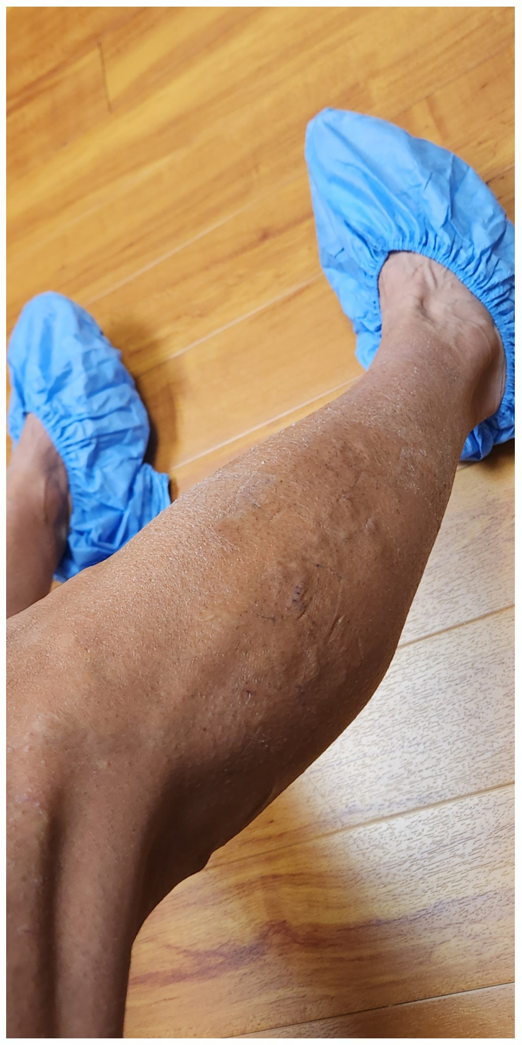 After Vein Treatment Allison Ward