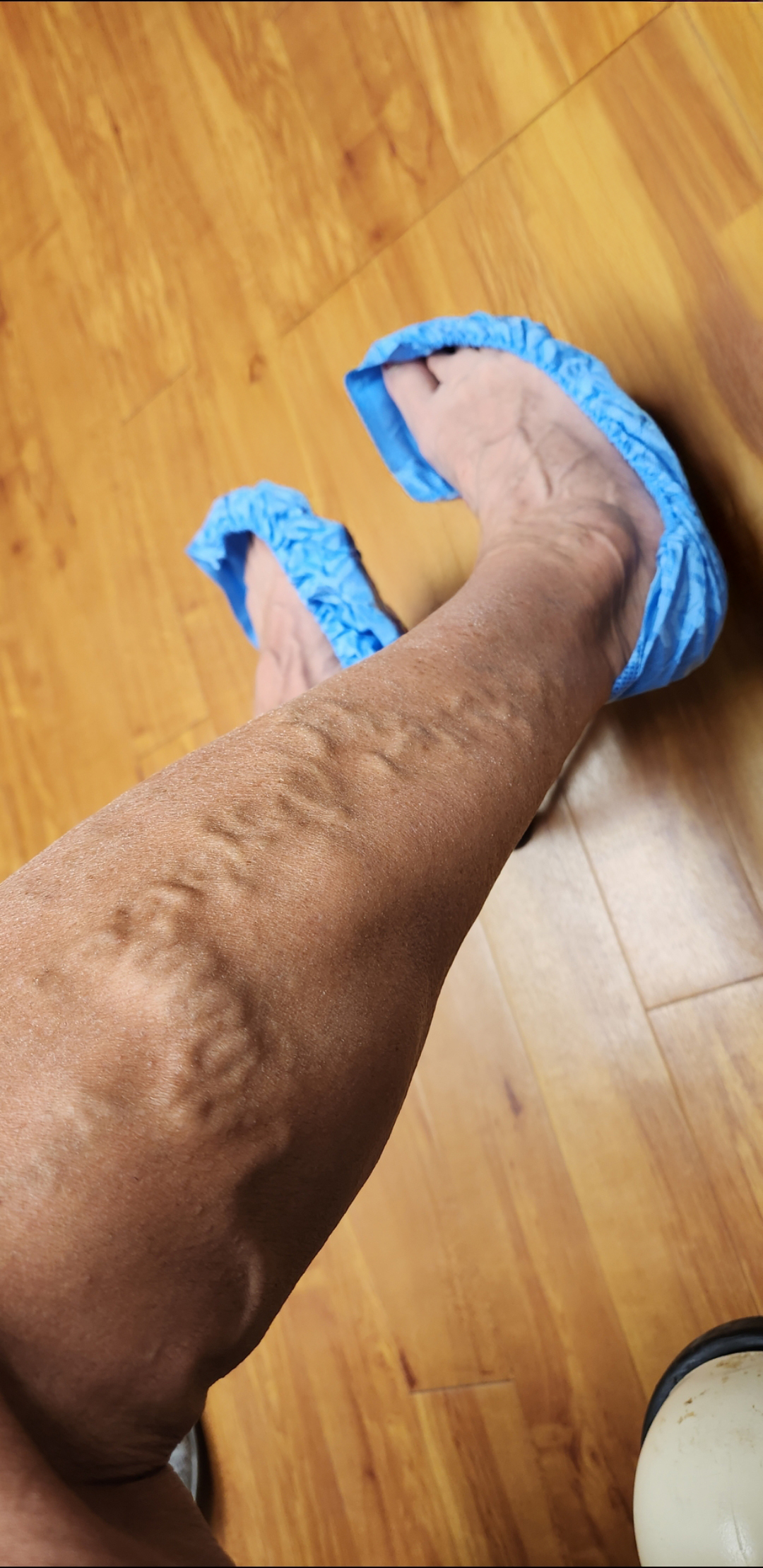 Before Vein Treatment Allison Ward