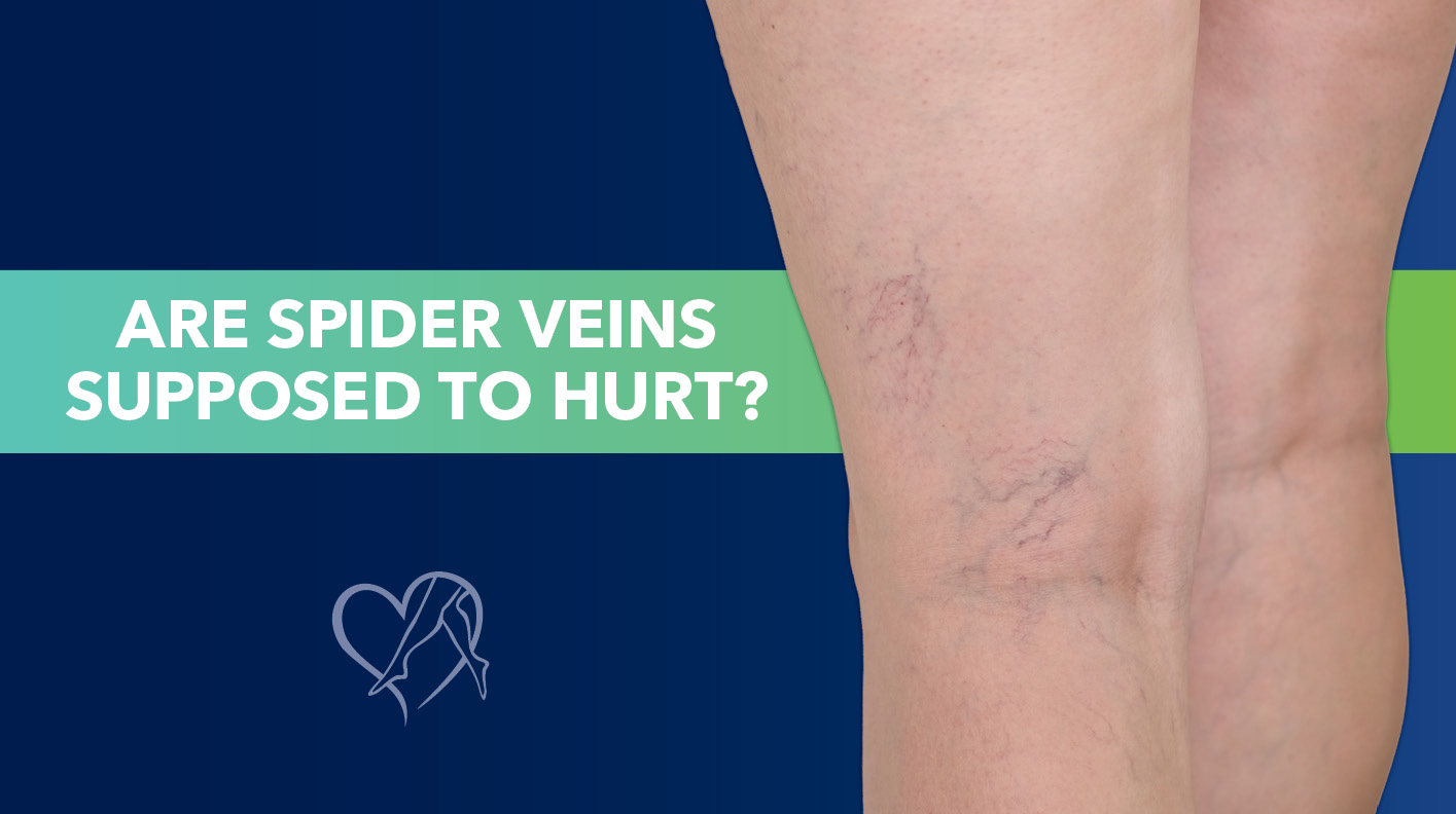 Blog Are Spider Veins Supposed to Hurt