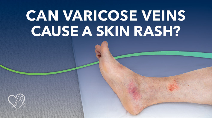 Blog Can Varicose Veins Casue a Skin Rash