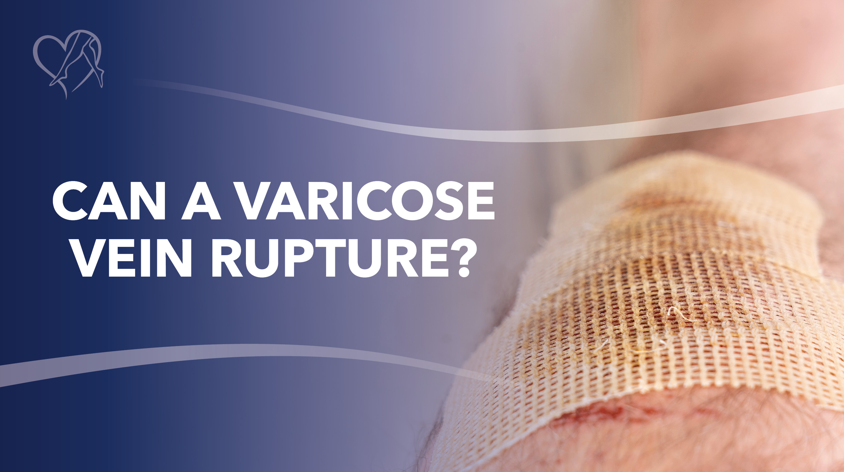 Blog Can a Varicose Vein Rupture 2026