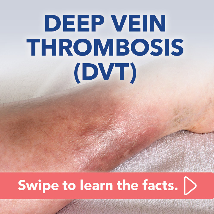 Blog Carousel Blood Clots In Athletes DVT