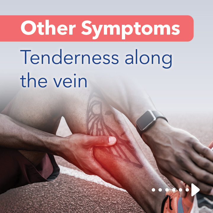 Blog Carousel Blood Clots In Athletes DVT6