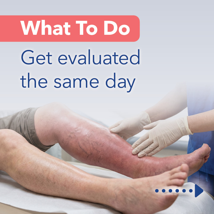 Blog Carousel Blood Clots In Athletes DVT7