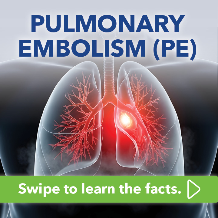Blog Carousel Blood Clots In Athletes PE