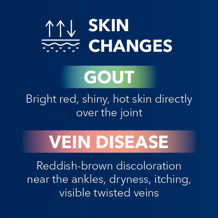 Blog Slider Gout vs Vein Disease5