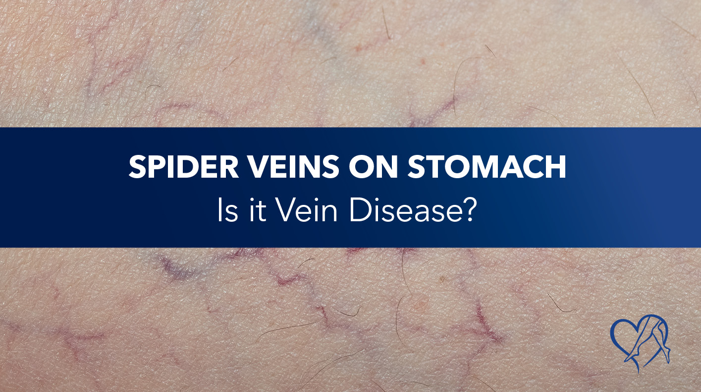 Spider Veins on Stomach: Is It Vein Disease?