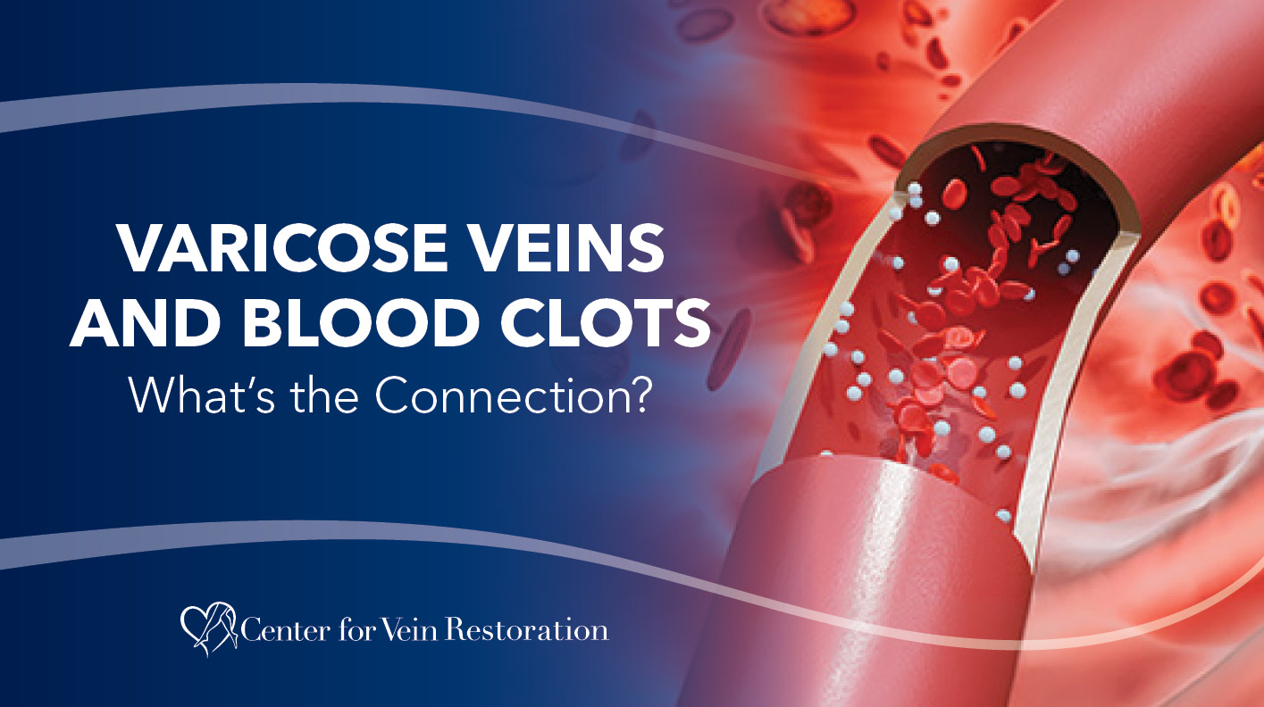 Blog Varicose Veins and Blood Clots