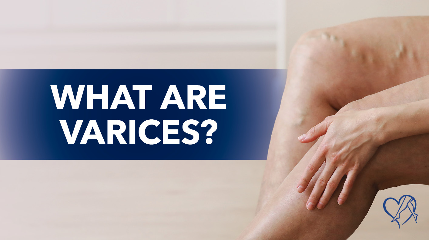 Blog What Are Varices 2026