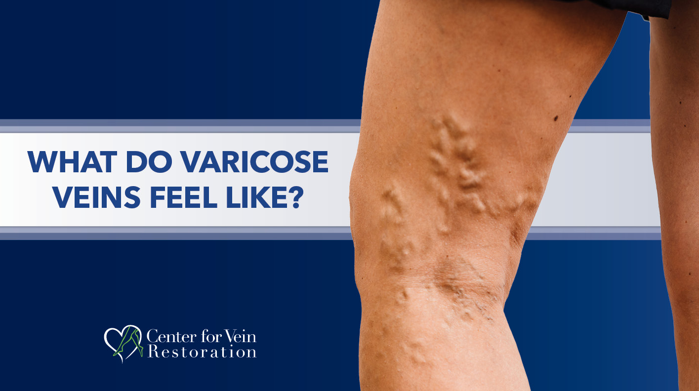 Blog What Do Varicose Veins Feel Like