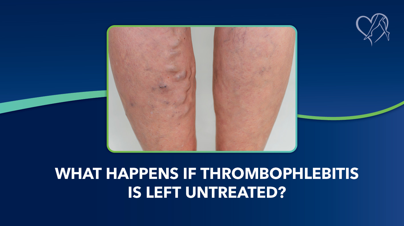 Blog What Happens if Thrombophlebitis Is Left Untreated Use