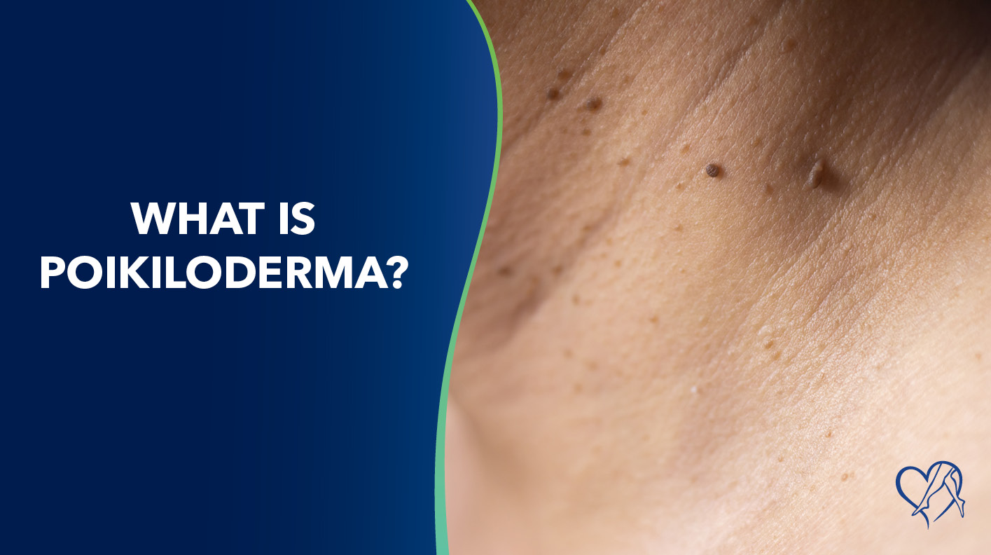 Blog What Is Poikiloderma