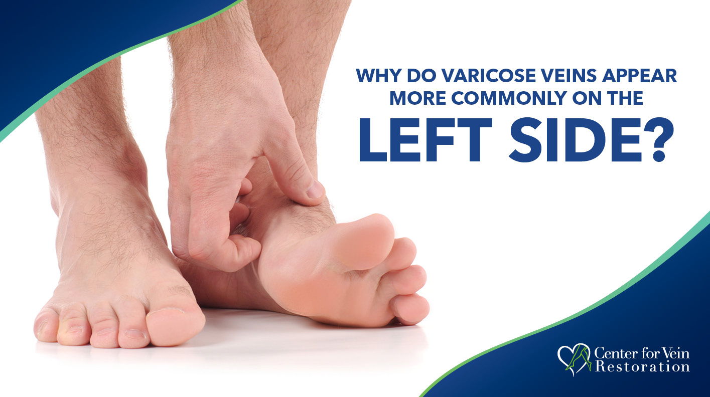 Blog Why Do Varicose Veins Appear on Left Side