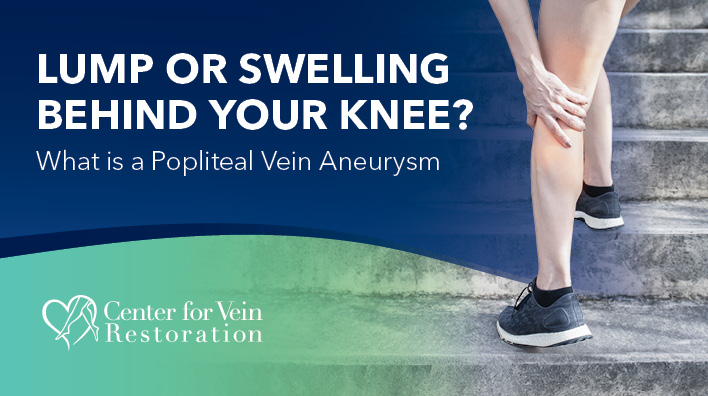Blog Image Lump or Swelling Behind Your Knee What is a Popliteal Vein Aneurysm