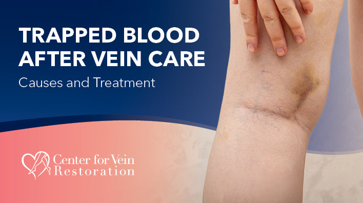 Blog Image Trapped Blood After Vein Care