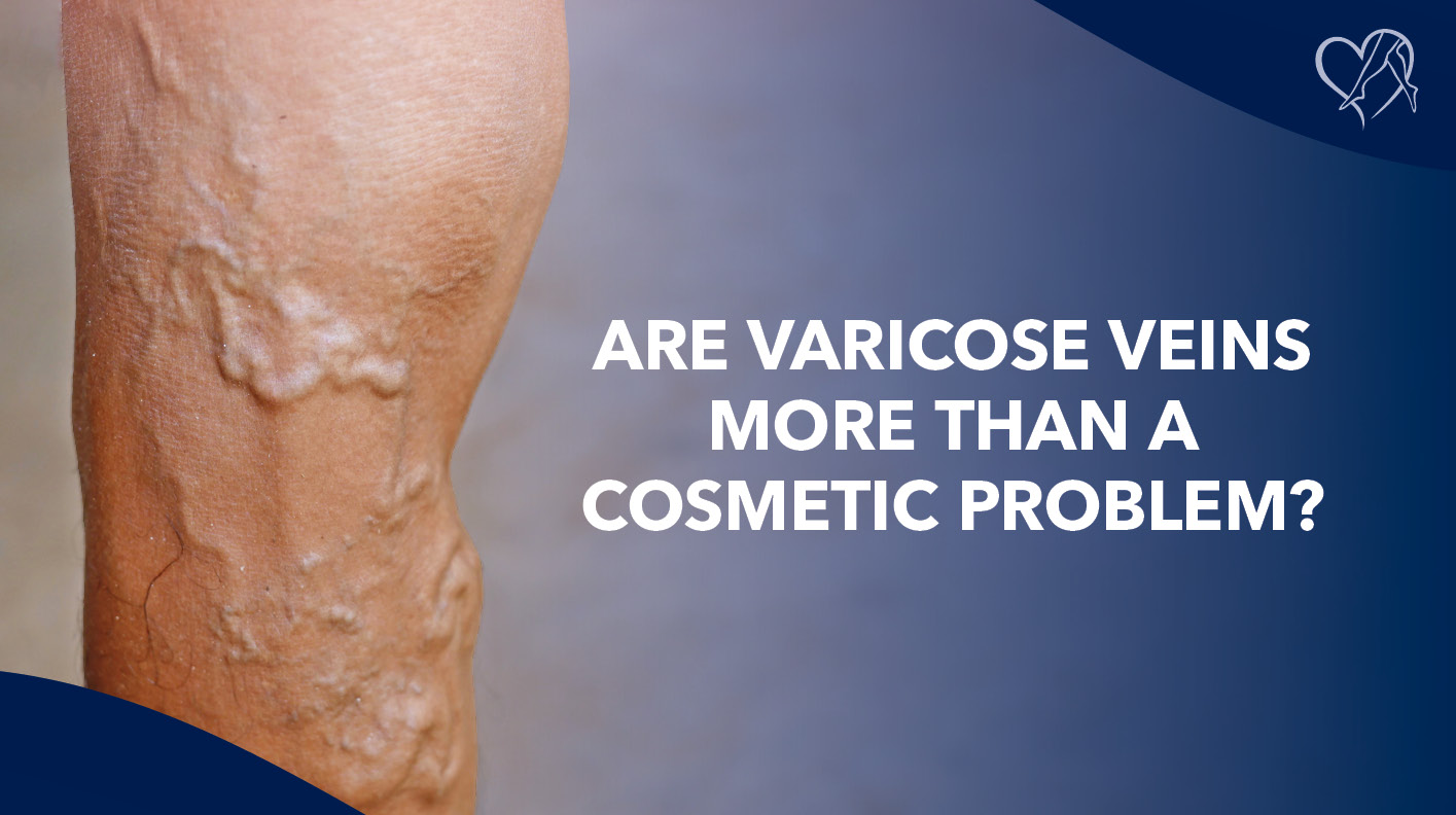 Blog Image Are Varicose Veins More than a Cosmetic Problem