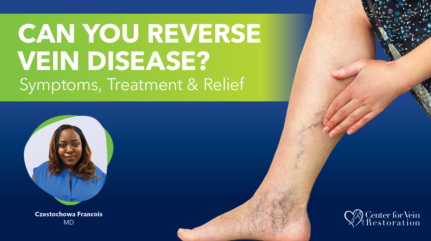 Blog Image Can You Reverse Vein Disease Symptoms Treatment Relief