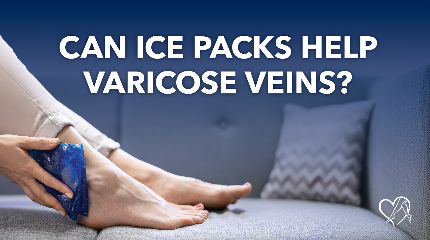 Blog Image Can Ice Packs Help Varicose Veins 2026 Thumbnail 2