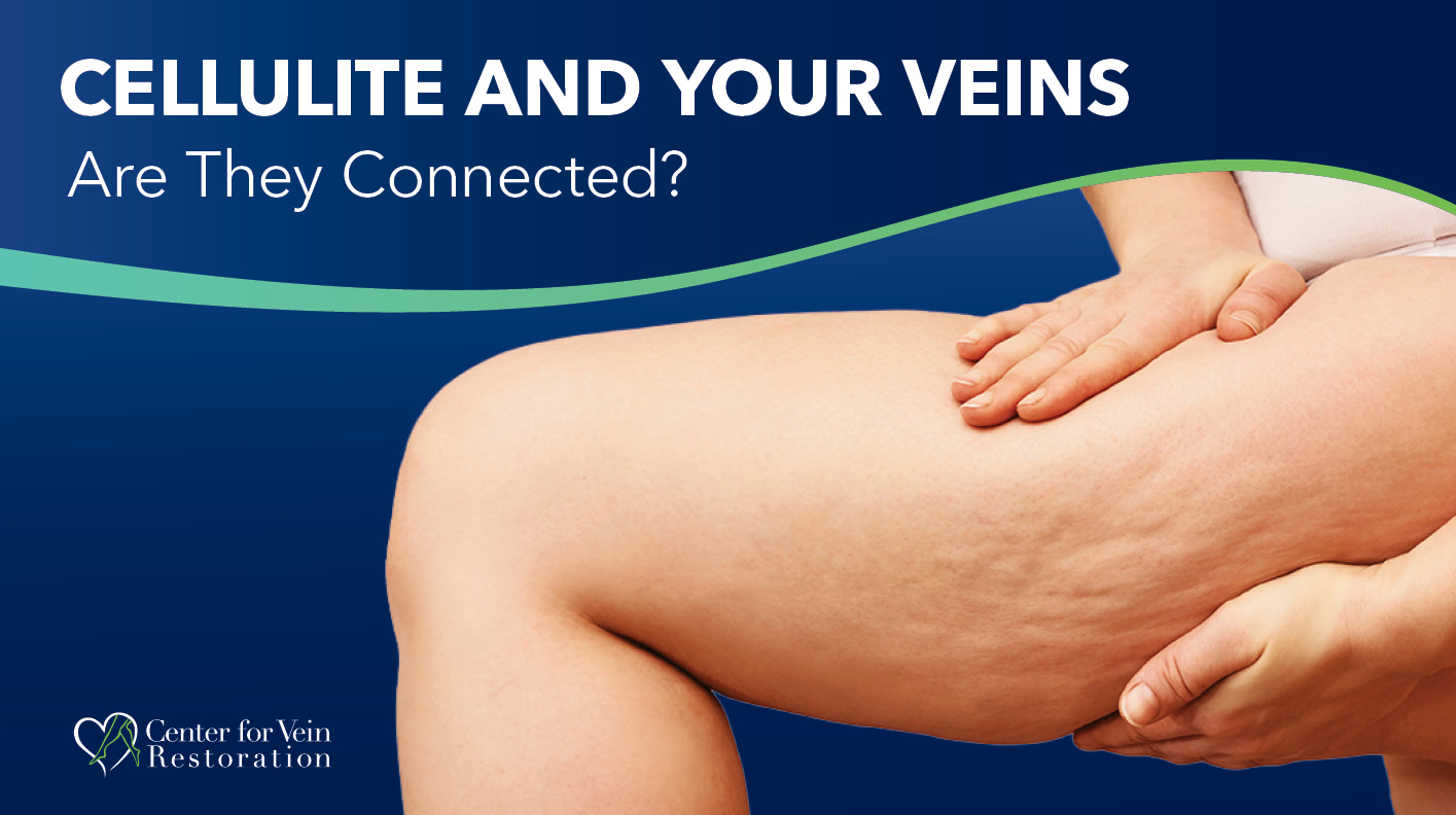 Blog Image Cellulite And Your Veins