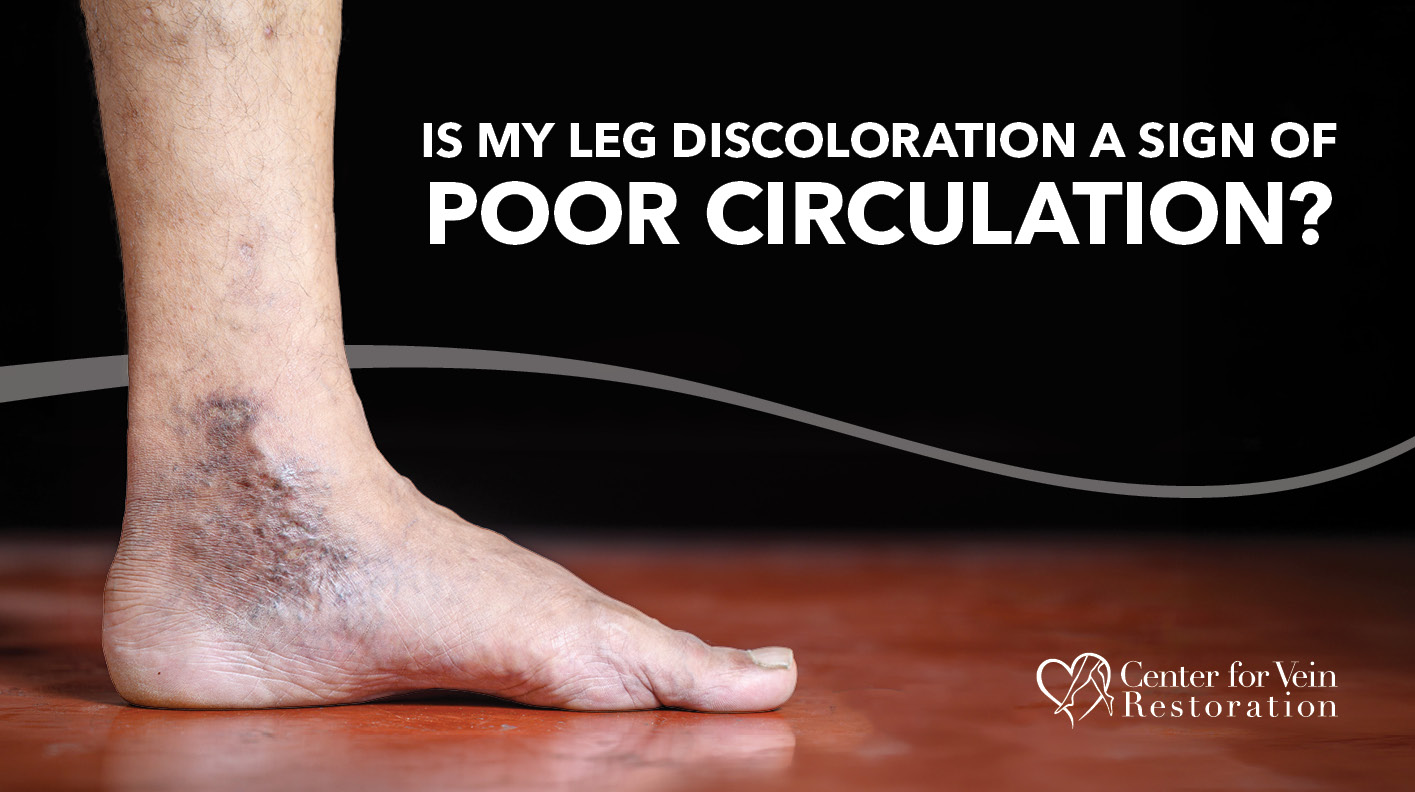 Blog Image Is My Leg Discoloration Due to Poor Circulation 2026