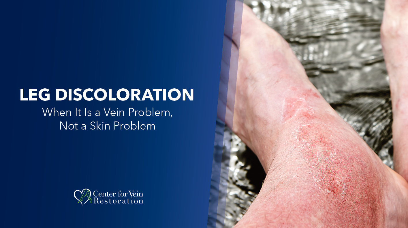 Blog Image Leg Discoloration