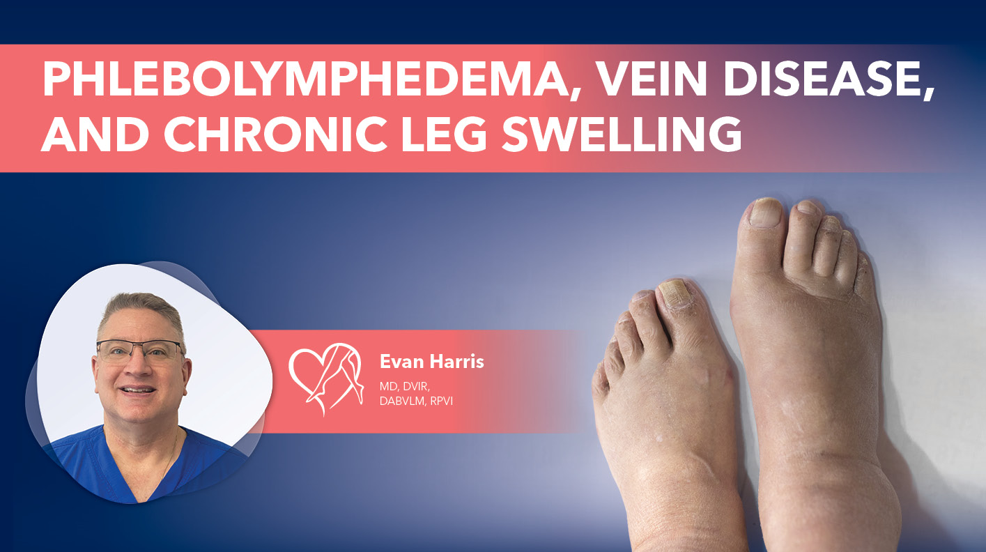 Blog Image Phlebolymphedema