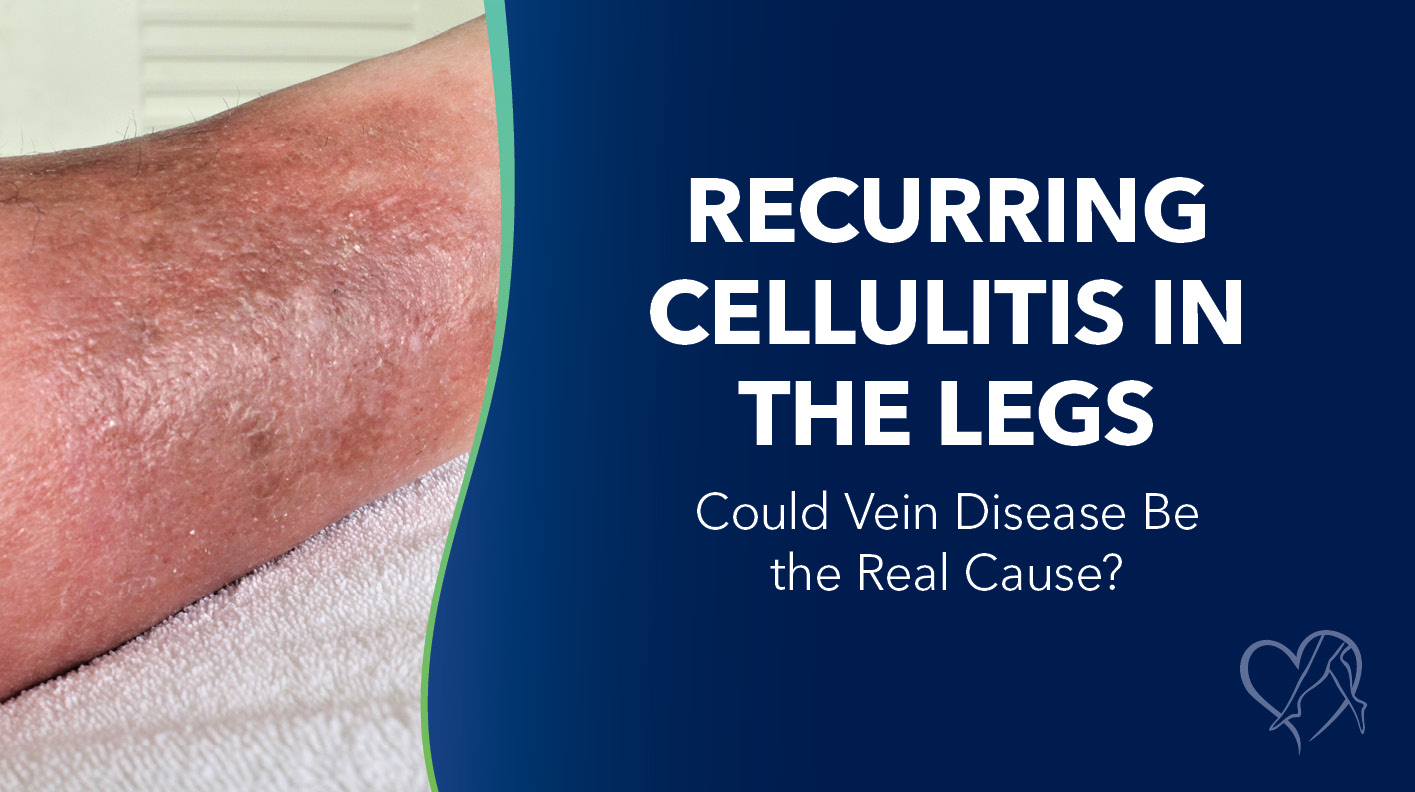 Blog Image Recurring Cellulitis in the Legs Thumbnail 1