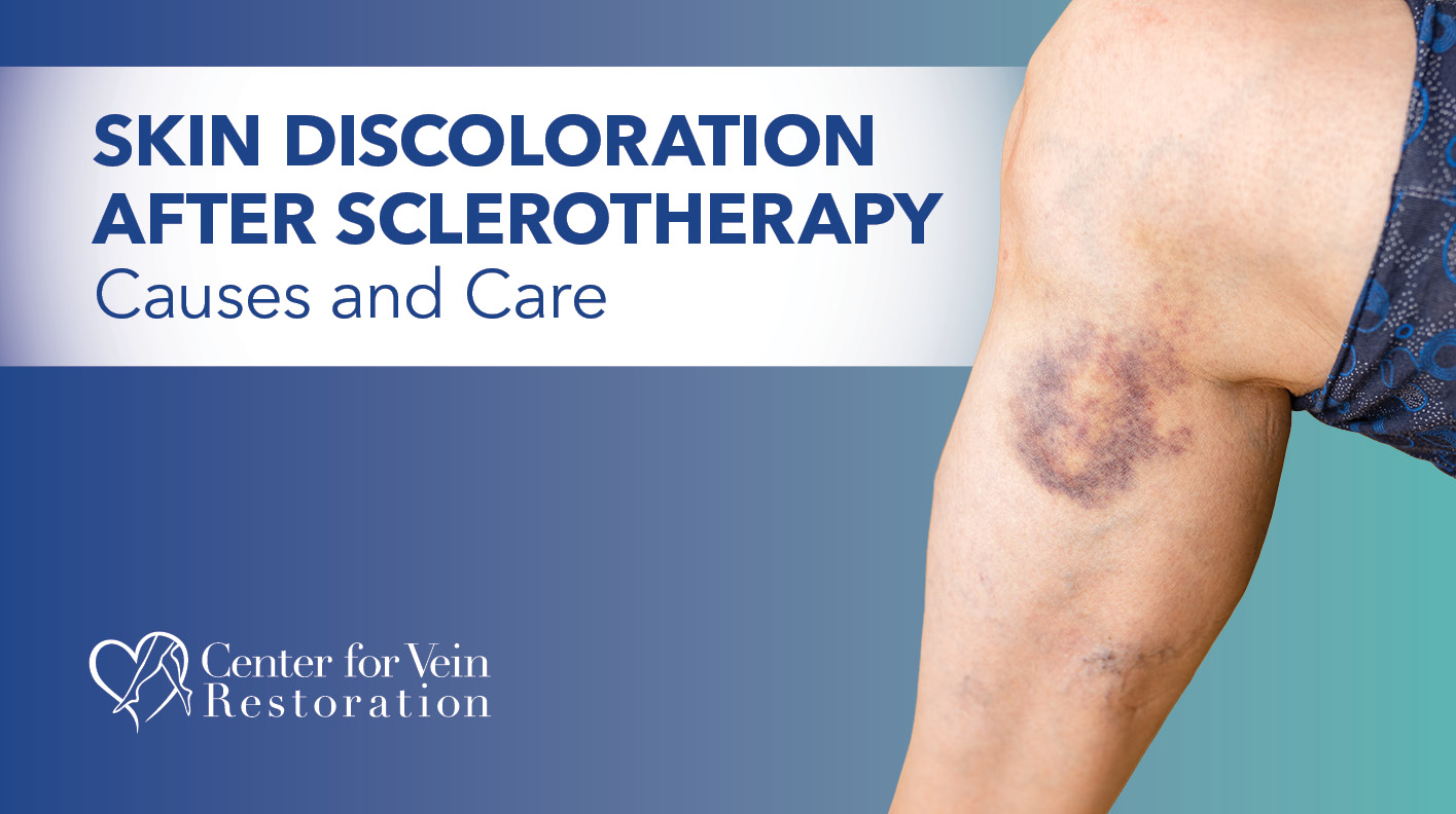 Blog Image Skin Discoloration After Sclerotherapy
