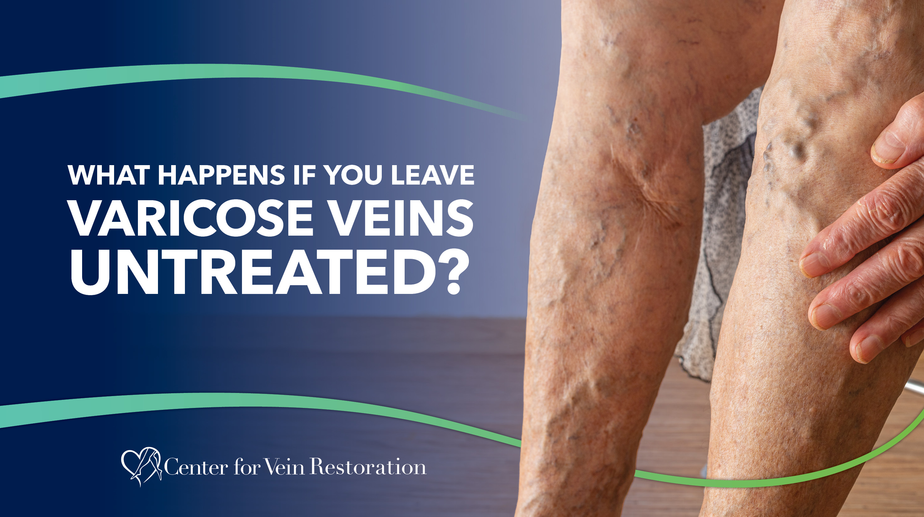 Blog Image What Happens If You Leave Varicose Veins Untreated