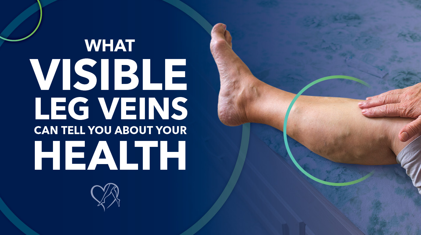 Blog Image What Visible Leg Veins Can Tell You About Your Health