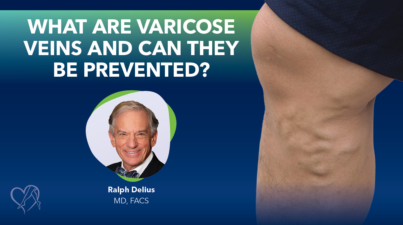 Blog Image What are Varicose Veins and Can They Be Prevented