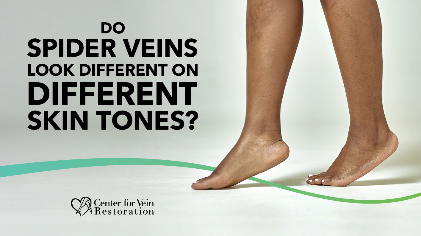 Blog Imge Do Spider Veins Look Different on Different Skin Tones