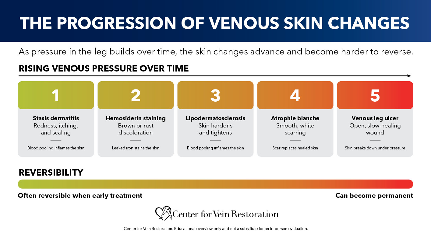 Blog Chart Leg Discoloration The Progression Of Venous Skin Changes