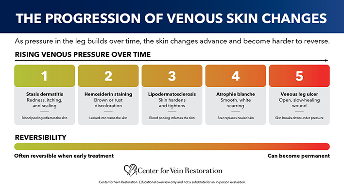 Blog Chart Leg Discoloration The Progression Of Venous Skin Changes 2026 07 17 sm