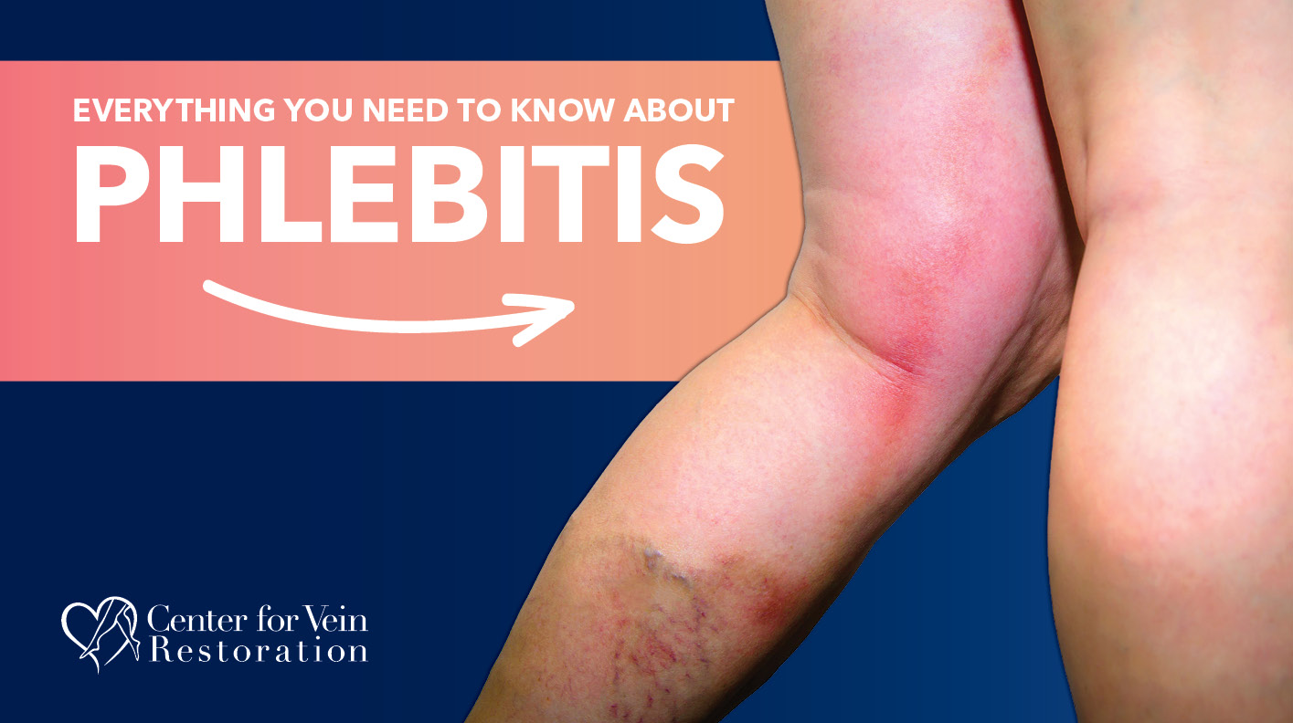 Blog Everything You Needto Know About Phlebitis 2026