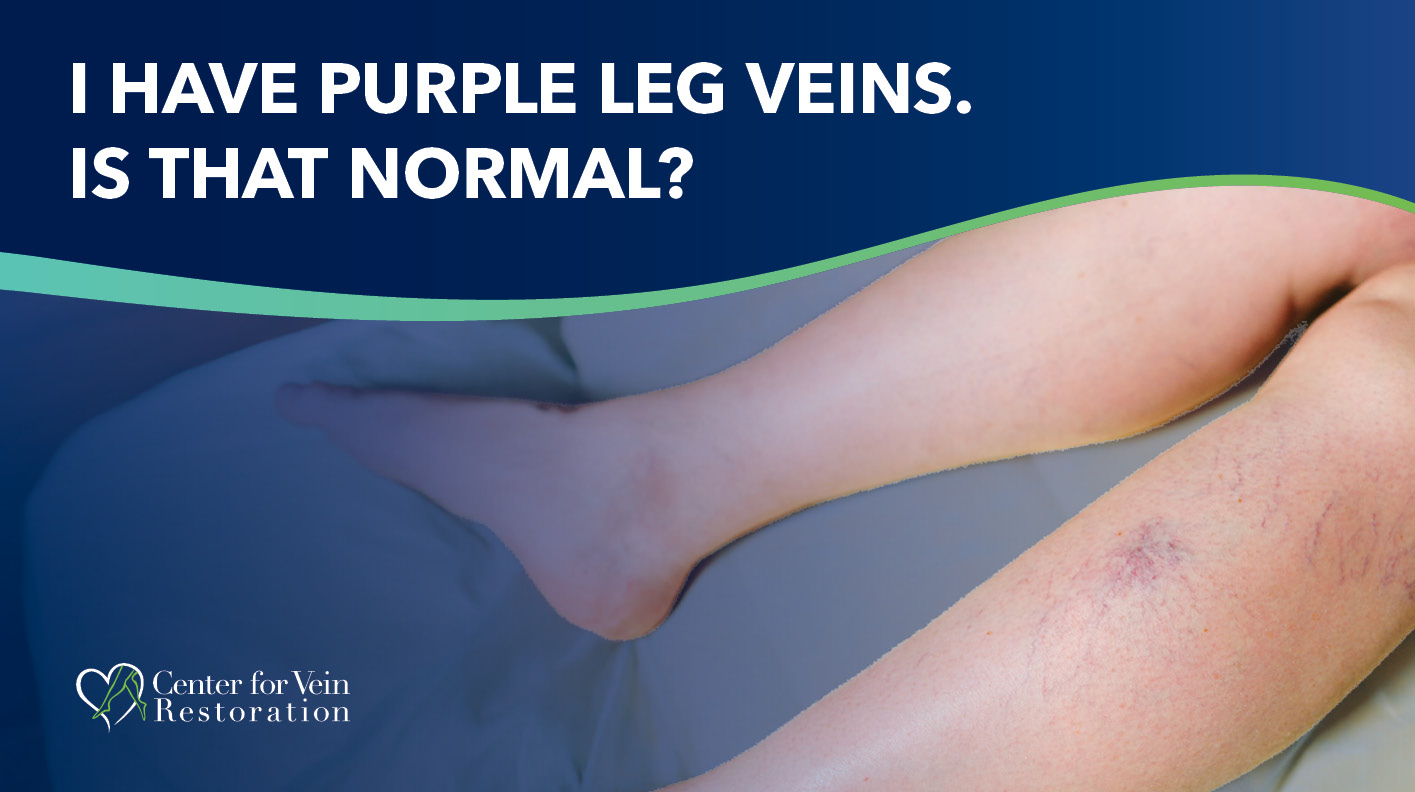 Blog I Have Purple Leg Veins Is That Normal