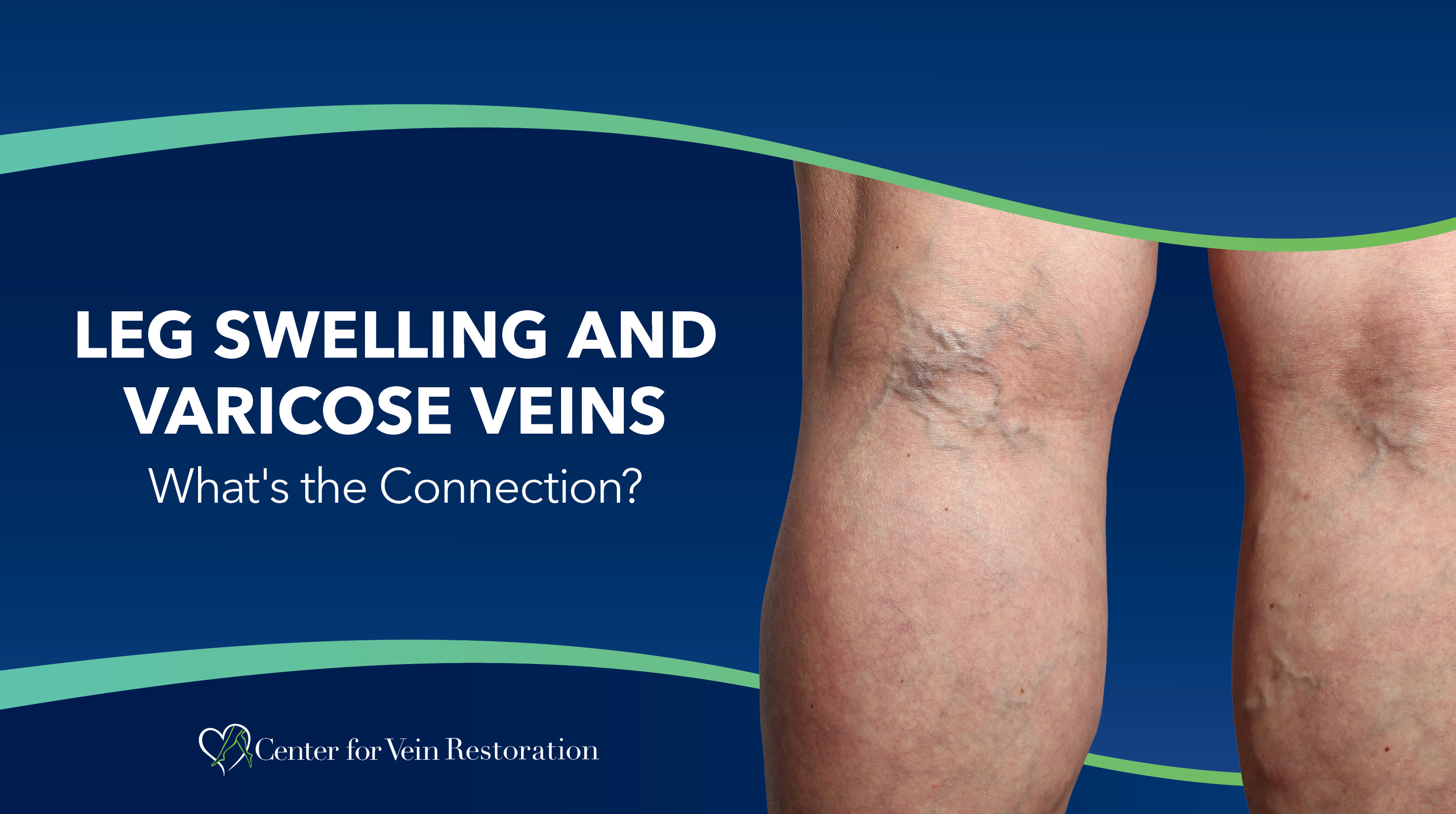 Blog Leg Swelling And Varicose Veins