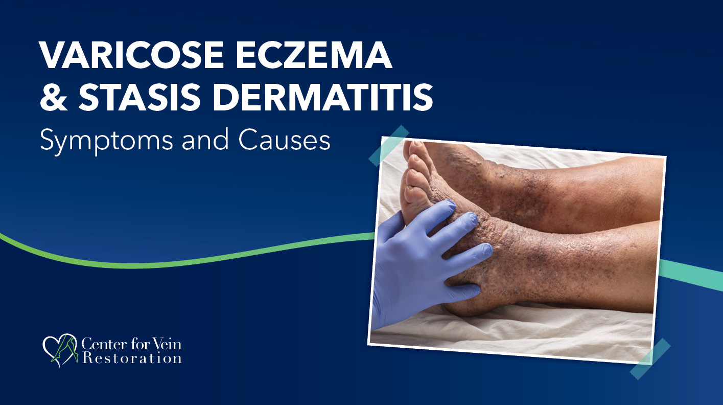 Blog Varicose Eczema Stasis Dermatitis 2026
