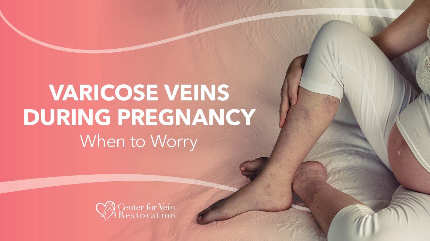 Blog Varicose Veins During Pregnancy When To Worry