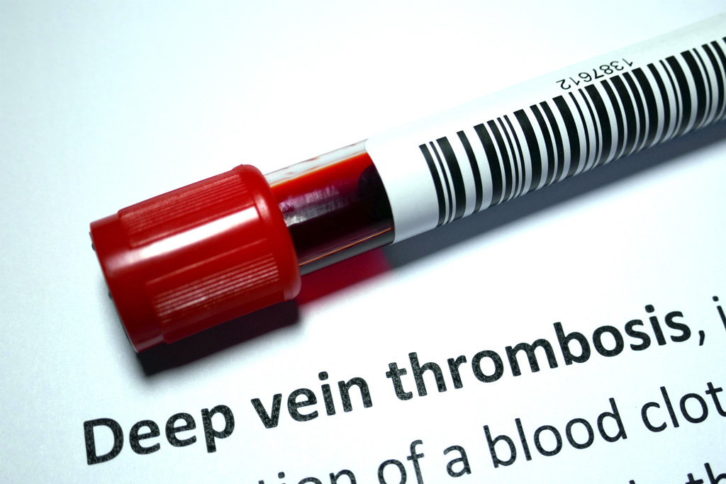 DVT Blog