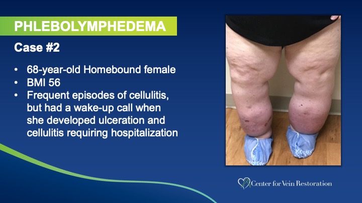 Slide1 Phlebolymphedema