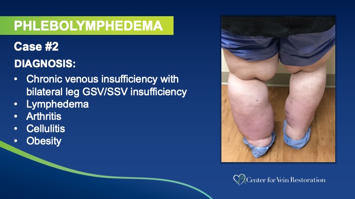 Slide2 Phlebolymphedema