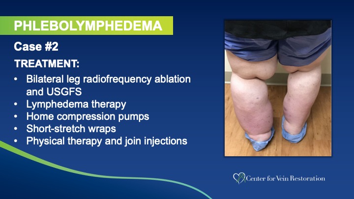 Slide3 Phlebolymphedema