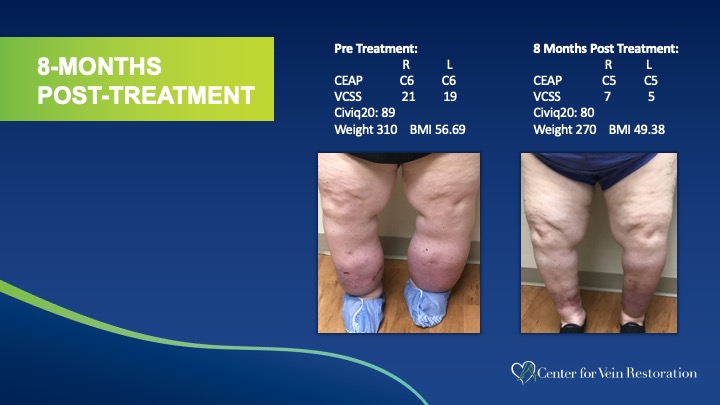 Slide4 Phlebolymphedema