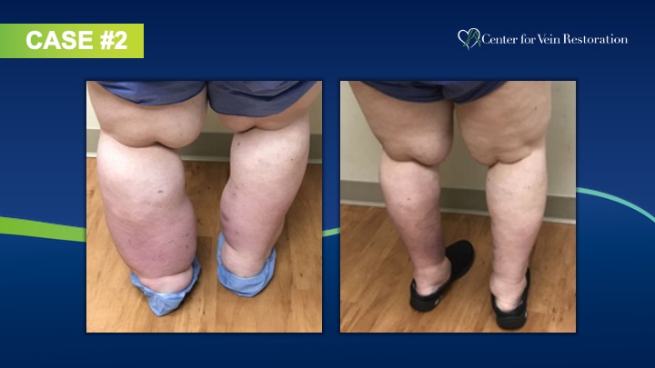 Slide5 Phlebolymphedema