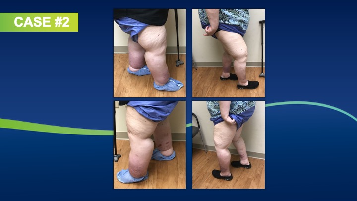 Slide6 Phlebolymphedema