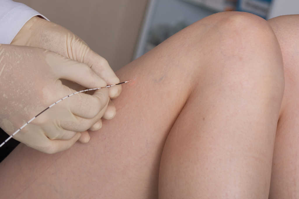 tratamiento seguro de las venas de las piernas cvr
