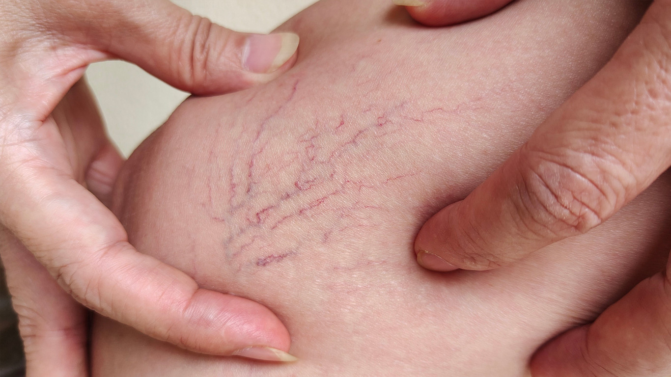 5 Facts About Spider Veins