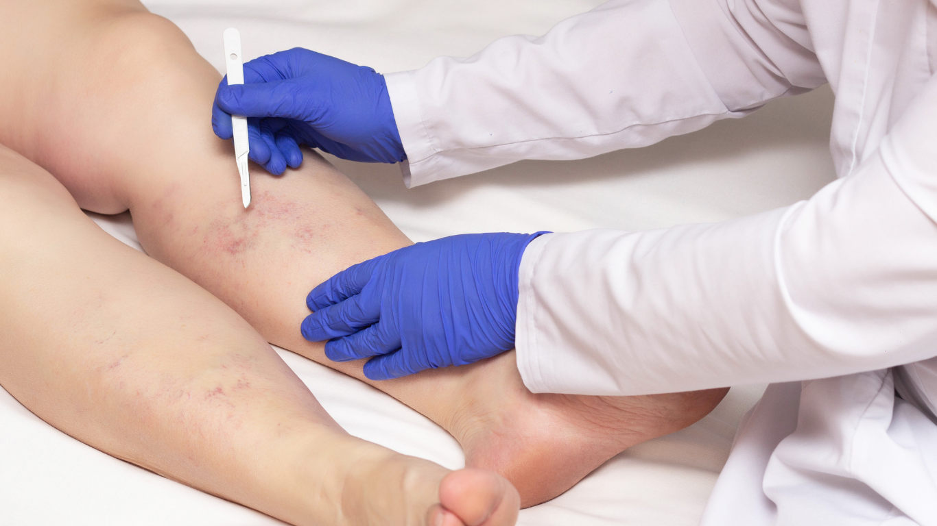 5 red flags you might have vein disease