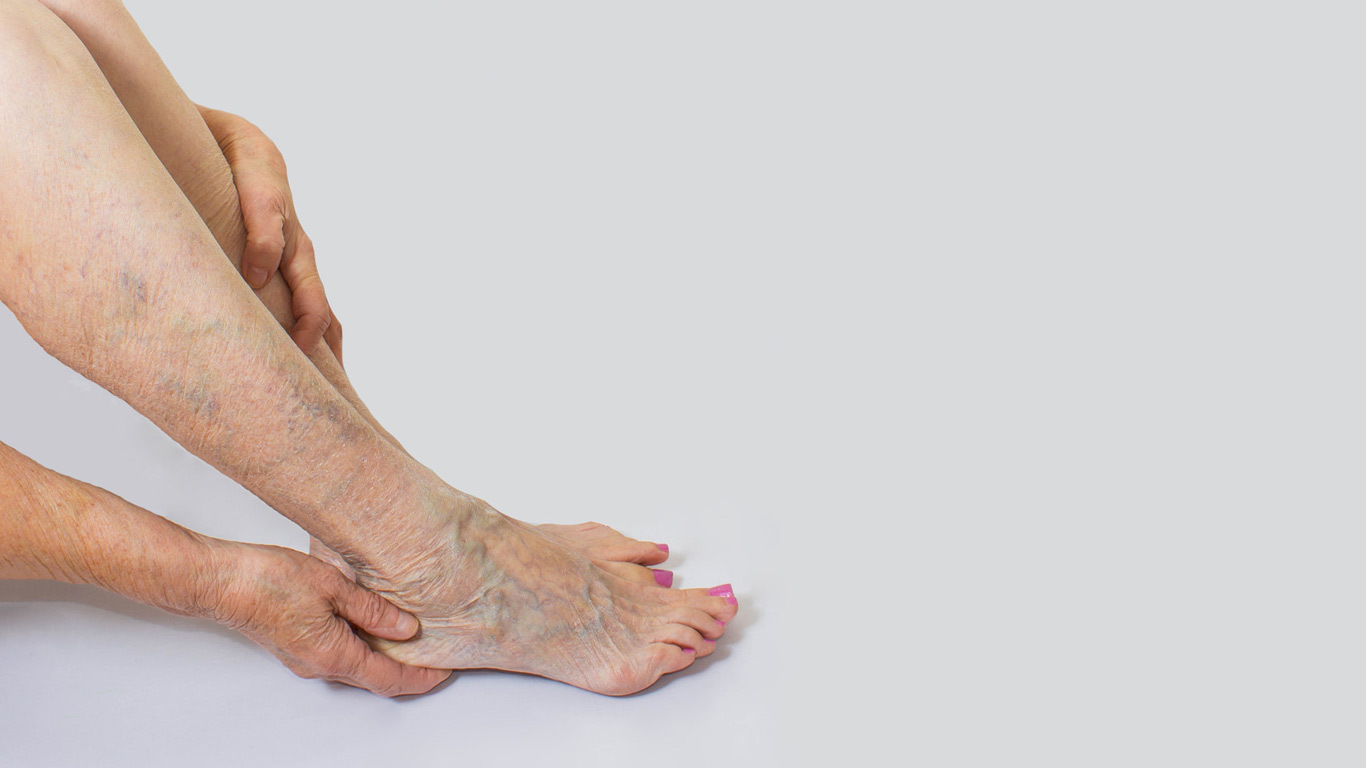 Are Spider Veins a Health Concern